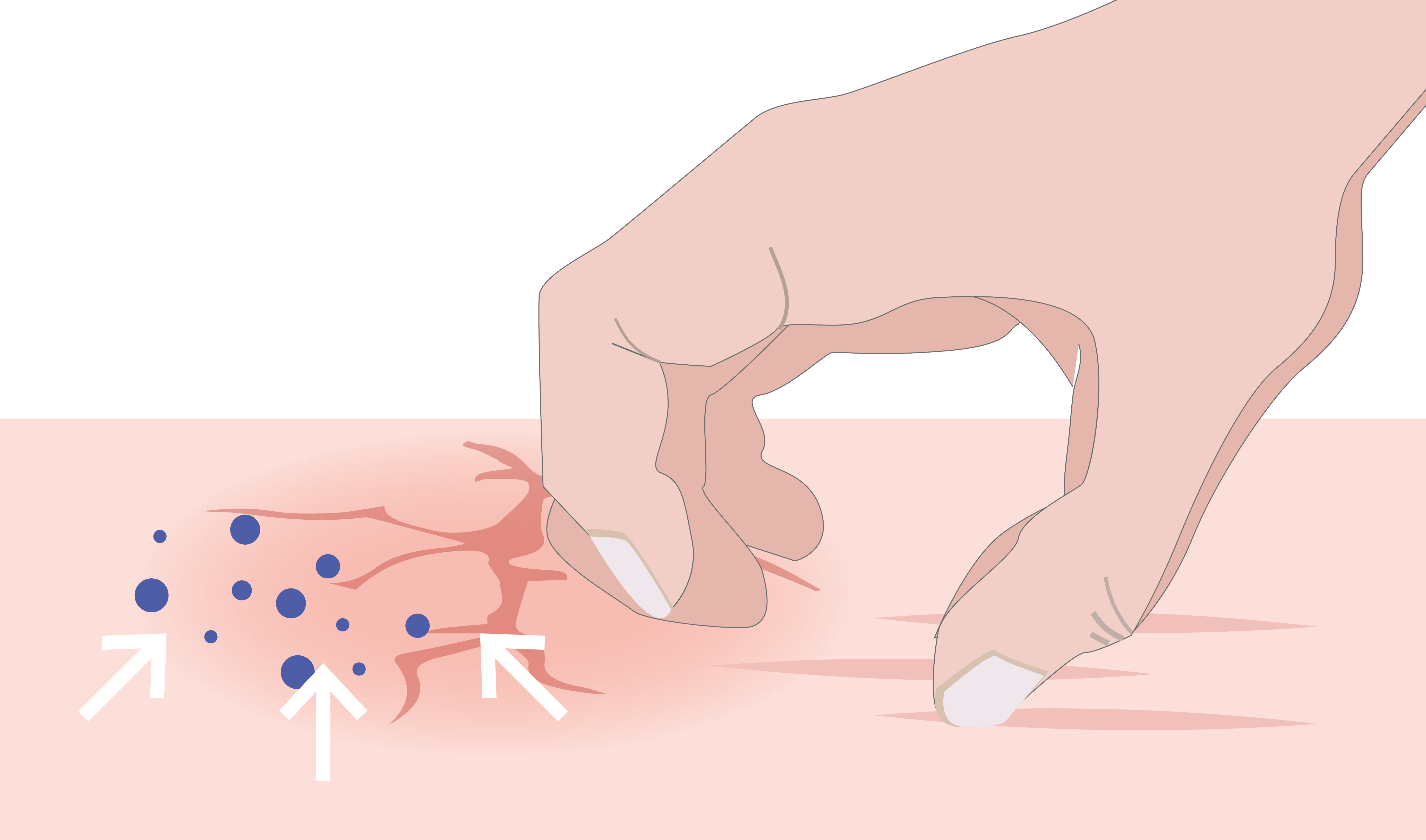 Illustrierte Darstellung einer die Hand, die Haut aufkratzt. 