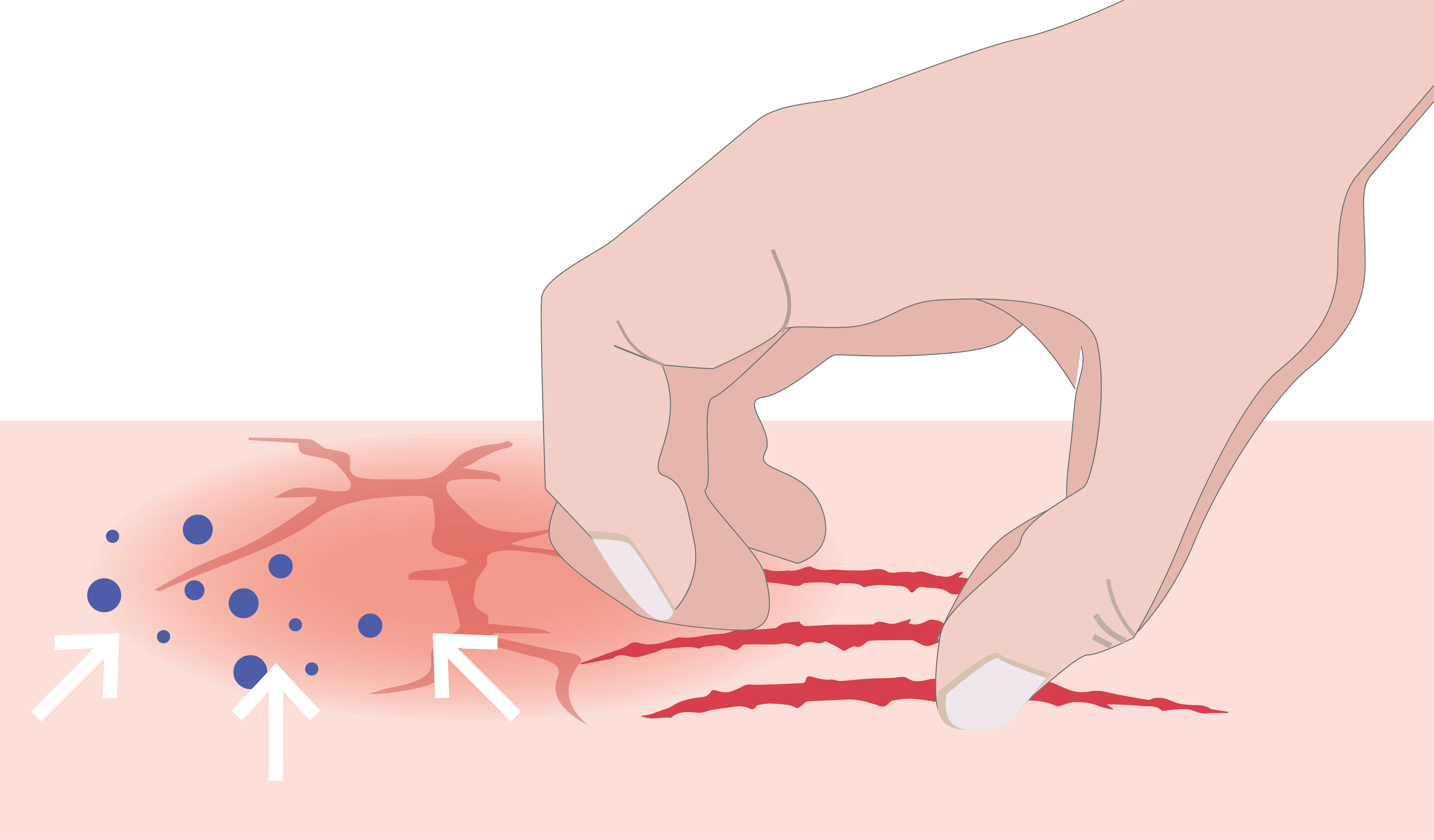 Illustrierte Darstellung einer die Hand, die Haut aufkratzt. 