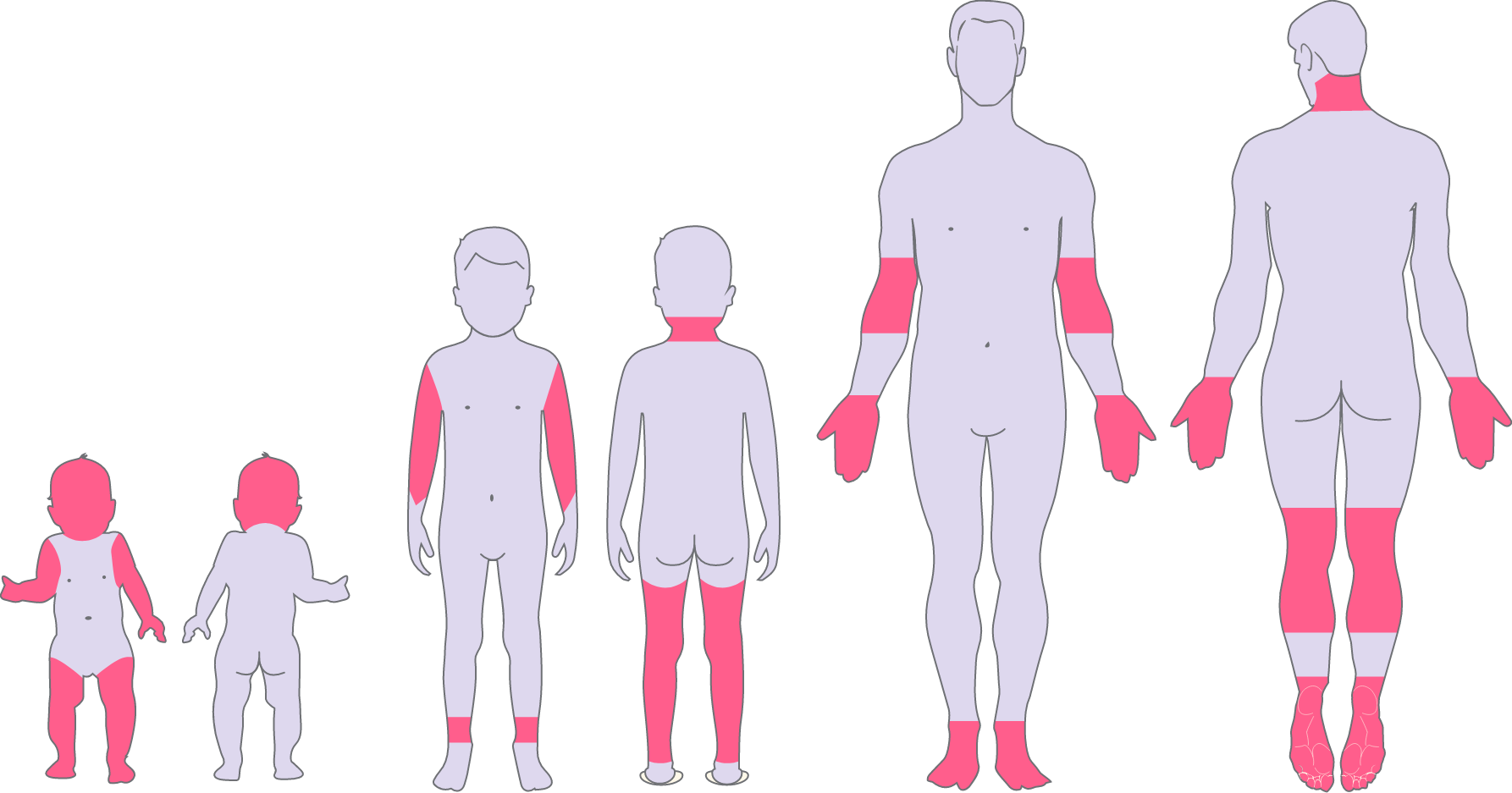 Eine Infografik die, oft betroffene Stellen an den Körpern von einem Baby, einem Kind und einem Erwachsenen aufzeigt. 