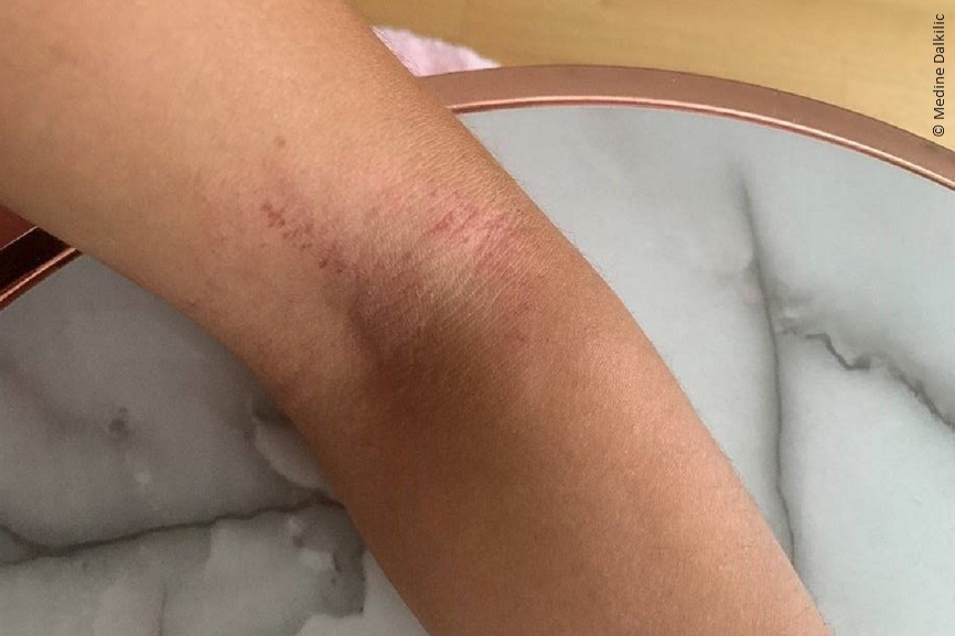 Auf Medines Armbeuge sind rote Flecken und trockene Stellen zu erkennen. 