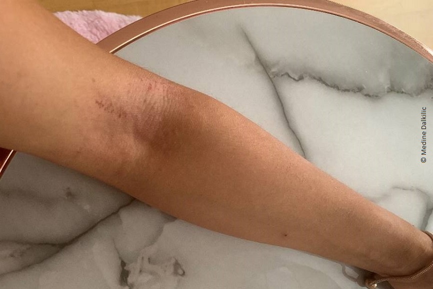 Die Armbeuge von Medine. Es sind rote und trockene Stellen am Arm zu sehen. 