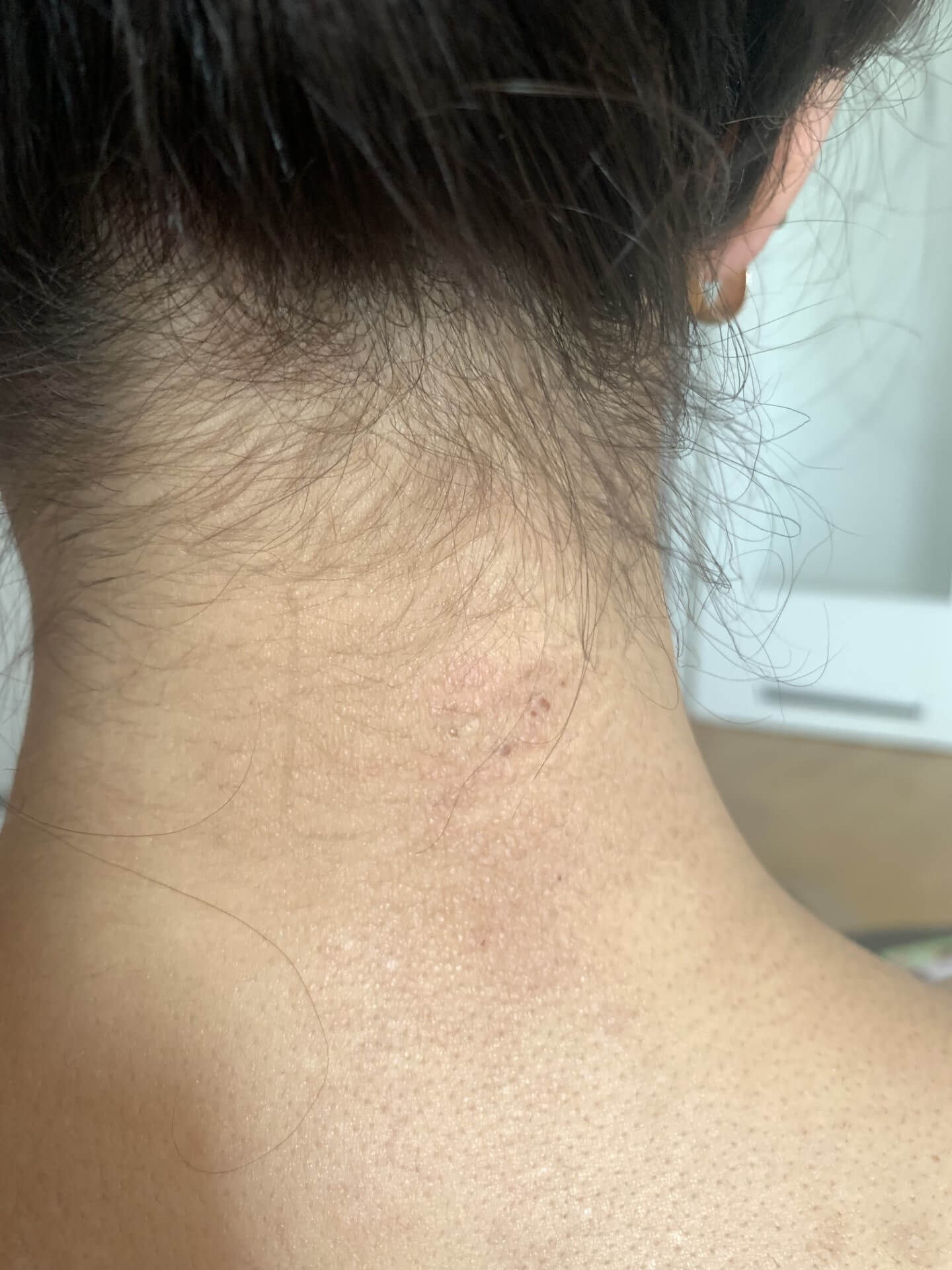 Nahaufnahme von Medines Nacken mit erkennbaren Rötungen. 