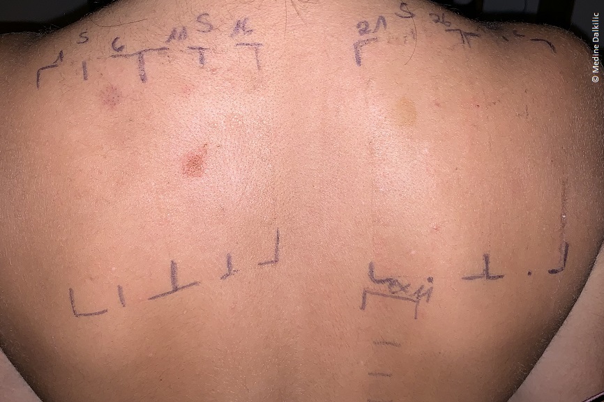 Ein Rücken auf dem mit Kugelschreiber Markierungen gemalt sind. Auf der Haut sind rote Stellen. 