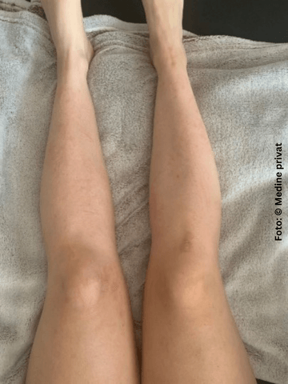 Medines Beine mit rissiger Haut und roten Stellen