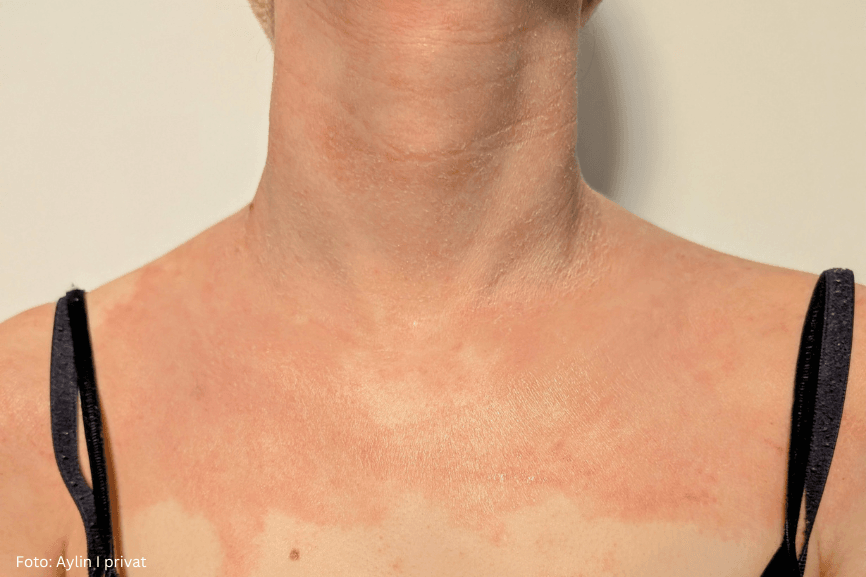 Das Bild zeigt Erfahrung mit Neurodermitis im Halsbereich