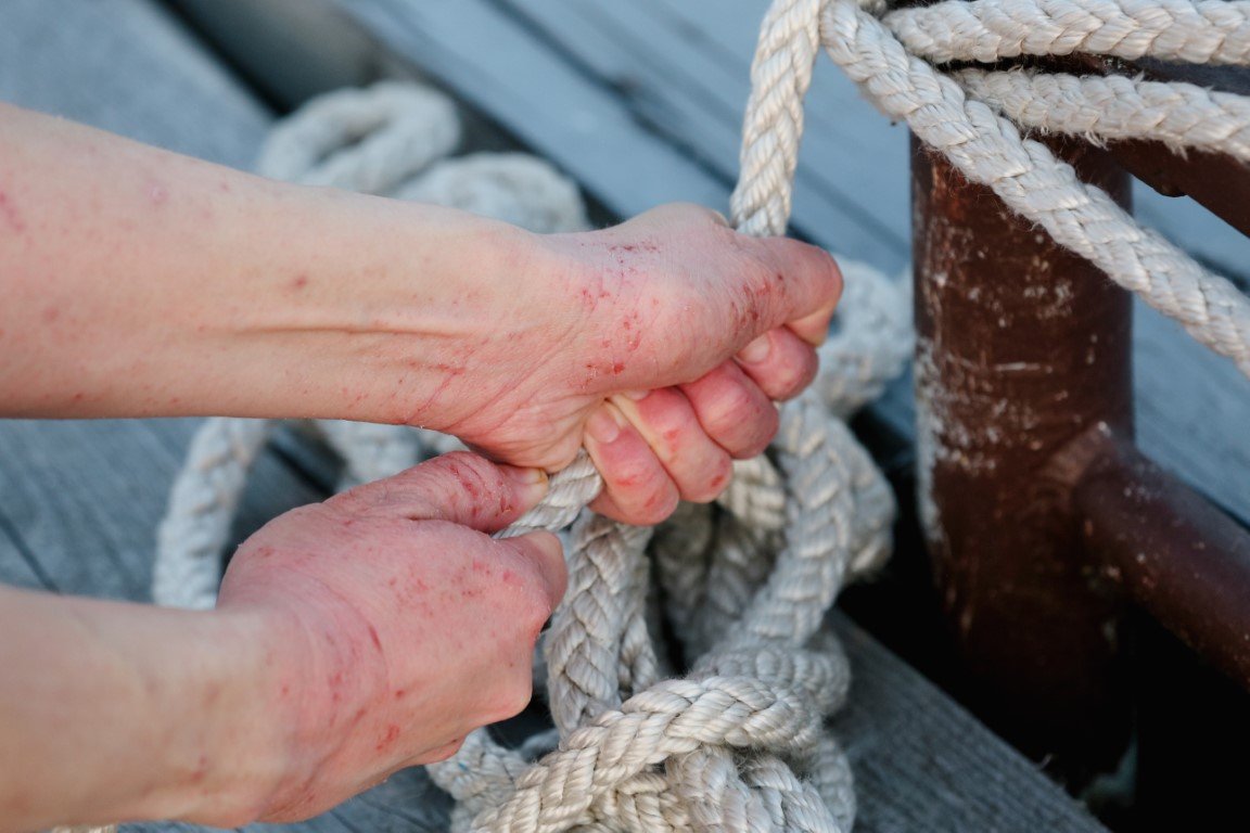 Hände mit sichtbaren Ekzemen, die ein Seil halten