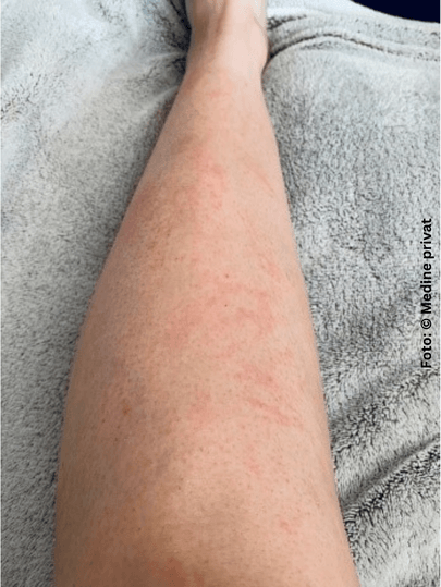 Rissige Haut und rote Stellen am linken Bein