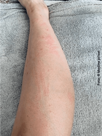 Medines Beine nach der Rasur mit Neurodermitis