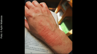 Blogübersicht - Ein Hingucker – Neurodermitis an den Händen