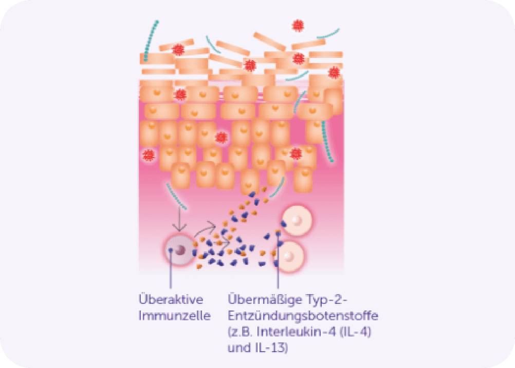 Darstellung der Hautbarriere im Falle von intakter Haut und bei Neurodermitis