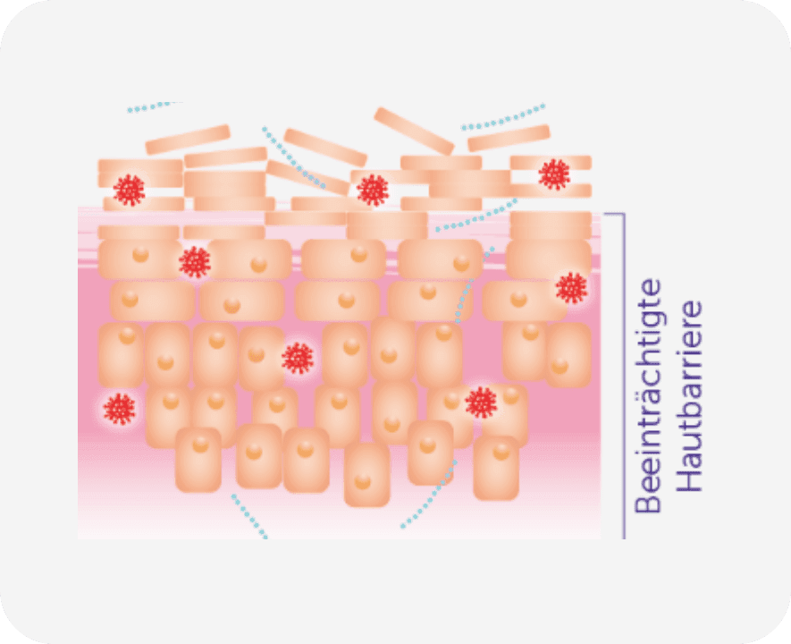 Darstellung der Hautbarriere im Falle von intakter Haut und bei Neurodermitis