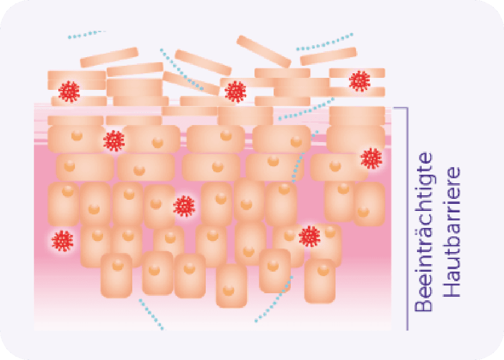 Darstellung der Hautbarriere im Falle von intakter Haut und bei Neurodermitis