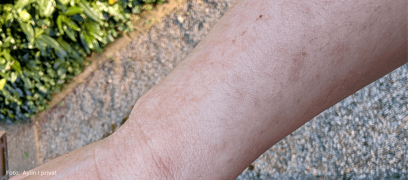 Ein Bild von Aylin – sie berichtet in einem Erfahrungsbericht über Neurodermitis und Pigmentflecken