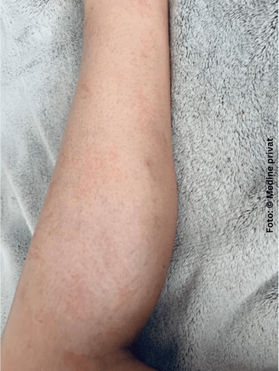 Ein Bein nach der Rasur mit Neurodermitis